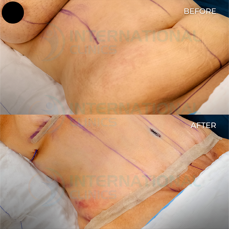  before and after images Mini Tummy Tuck